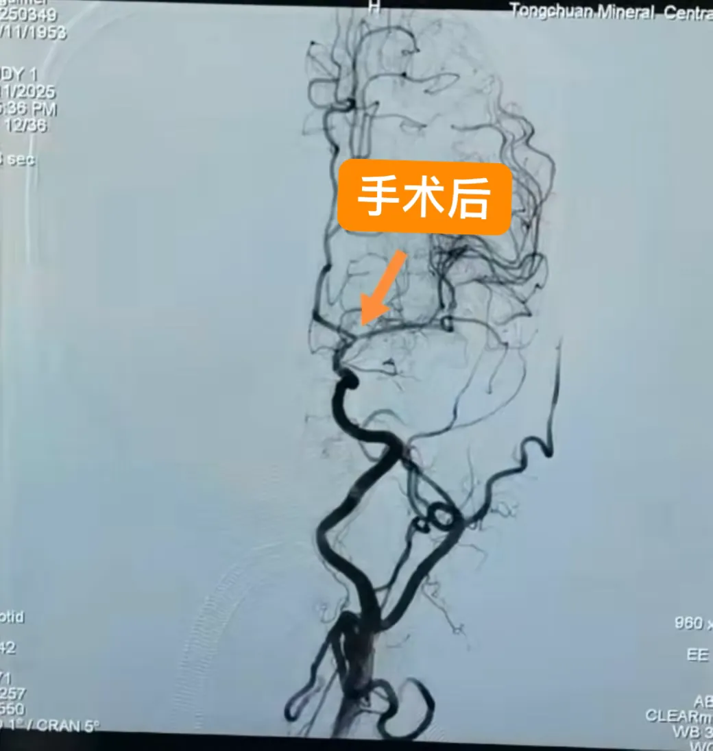 简篇-铜川矿务局中心医院成功实施铜川市首例左侧大脑中动脉慢性闭塞开通术