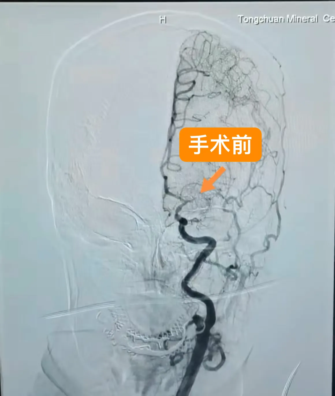 简篇-铜川矿务局中心医院成功实施铜川市首例左侧大脑中动脉慢性闭塞开通术